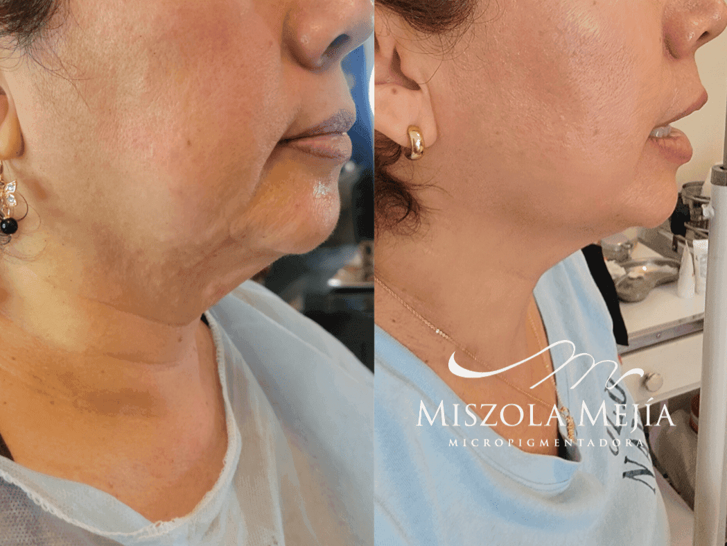 Resultado Lifting facial sin cirugía con HIFU — clienta real Misz Estética Lima