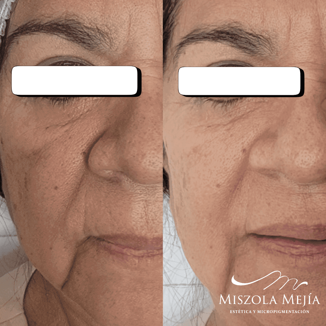 Facial Misz